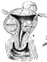 Fibroids Benign Tumours Uterus Womb